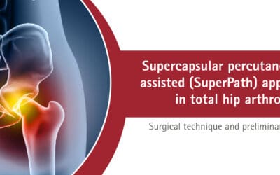 SuperPath approach in total hip arthroplasty