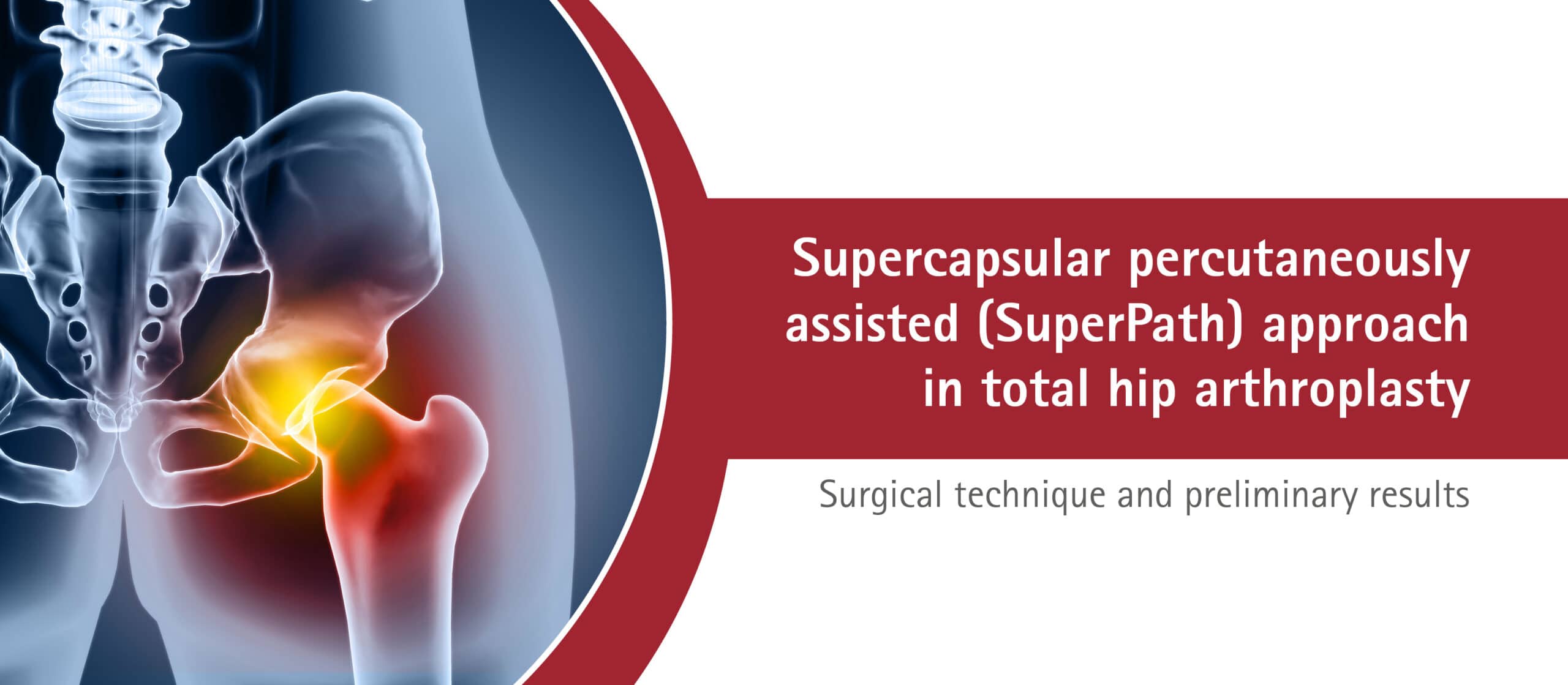SuperPath approach in total hip arthroplasty